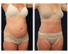 Abdominoplasty - Tummy Tuck