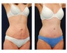 Abdominoplasty - Tummy Tuck