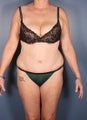 Tummy Tuck, Liposuction