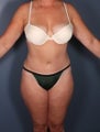 Tummy Tuck