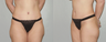 Abdominoplasty