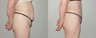 Abdominoplasty