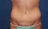 full abdominoplasty
