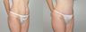 Abdominoplasty