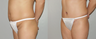 Abdominoplasty