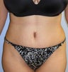 Tummy Tuck