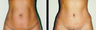 Tummy Tuck