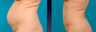 Tummy Tuck