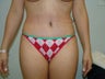 tummy tuck