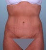 Tummy tuck