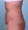 Tummy tuck