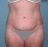 Tummy tuck