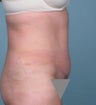 tummy tuck