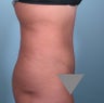 tummy tuck