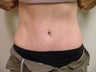 Abdominoplasty/Tummy Tuck 