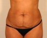 Abdominoplasty (Tummy Tuck)