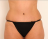 Abdominoplasty (Tummy Tuck)