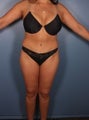 Tummy Tuck