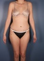 Tummy Tuck, Liposuction