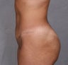 Tummy Tuck