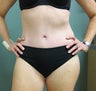 Abdominoplasty