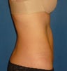 Mini-Abdominoplasty with VASER liposuction