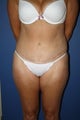 abdominopasty with suction-assisted lipectomy