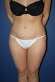 abdominoplasty with suction-assisted lipectomy