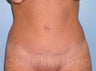 Tummy Tuck