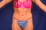 Tummy tuck