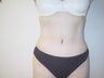 Tummy Tuck