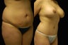 Tummy Tuck and Breast Augmentation- gel implants
