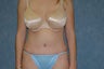 Tummy Tuck