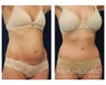 Abdominoplasty - Tummy Tuck