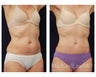 Abdominoplasty - Tummy Tuck