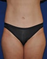 Tummy Tuck