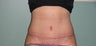 Abdominoplasty (Tummy Tuck)
