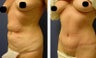 Tummy Tuck