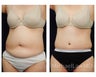 Abdominoplasty - Tummy Tuck