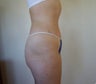 Tummy Tuck