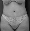 Tummy Tuck