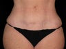 Tummy Tuck