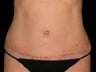 Tummy Tuck