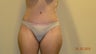 Tummy Tuck
