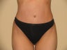 Tummy Tuck