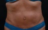 Abdominoplasty