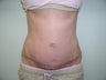 tummy tuck