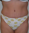 Tummy Tuck