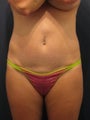 Abdominoplasty