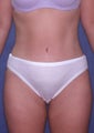 Tummy Tuck